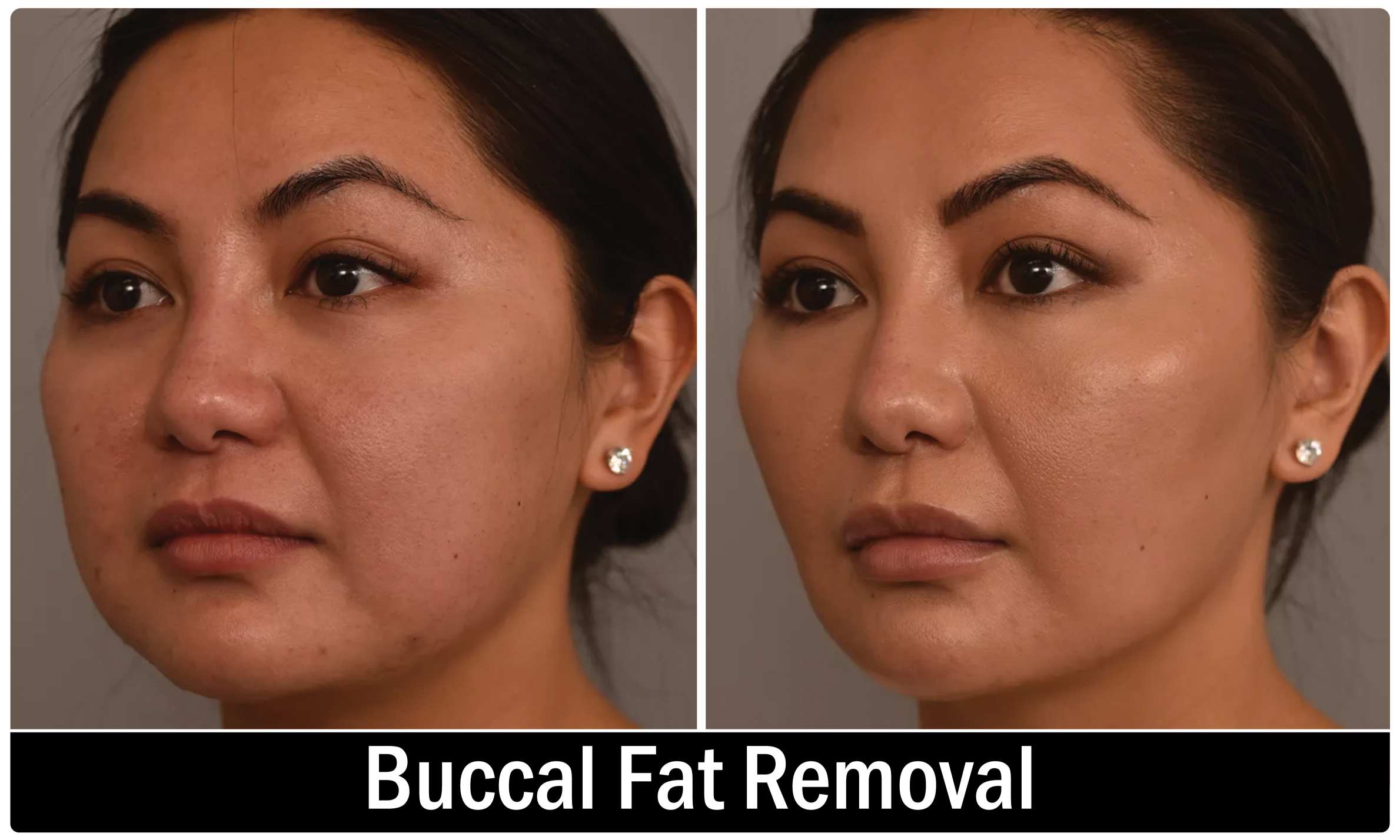 Buccal Fat Removal KOQ10